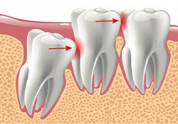 Illustration of impacted molar