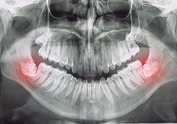 Profile view illustration showing impacted wisdom tooth with black background